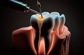 Endodoncia- Clínica dental Fernando Rodriguez