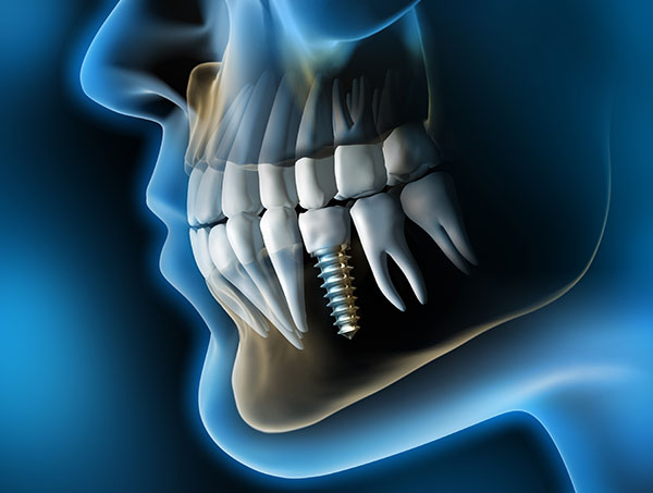 implantes dentales - Clínica dental Fernando Rodriguez