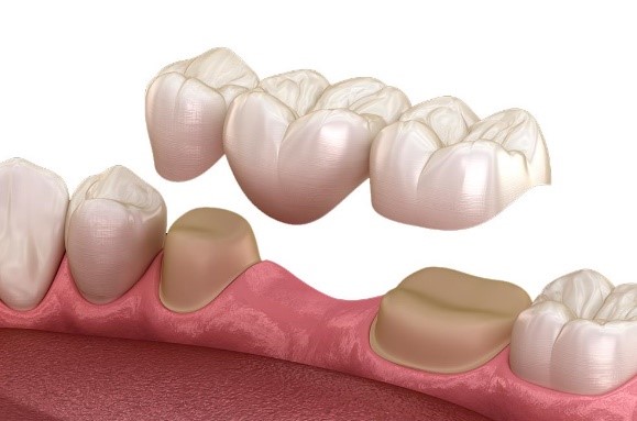 prostodoncia - Clínica dental Fernando Rodriguez